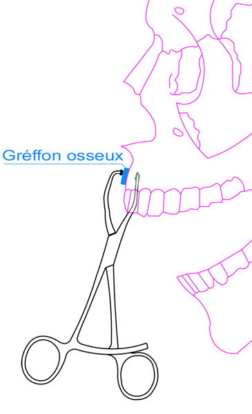Pinces à greffons osseux - mors asymétrique côté droit (CL021)